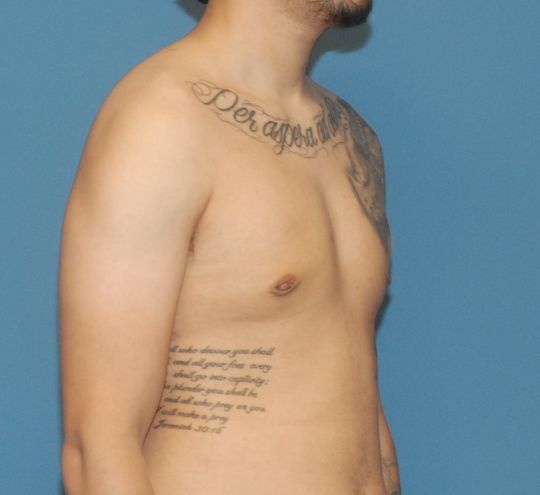 Gynecomastia Before & After