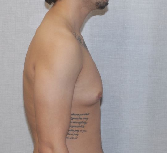 Gynecomastia Before & After