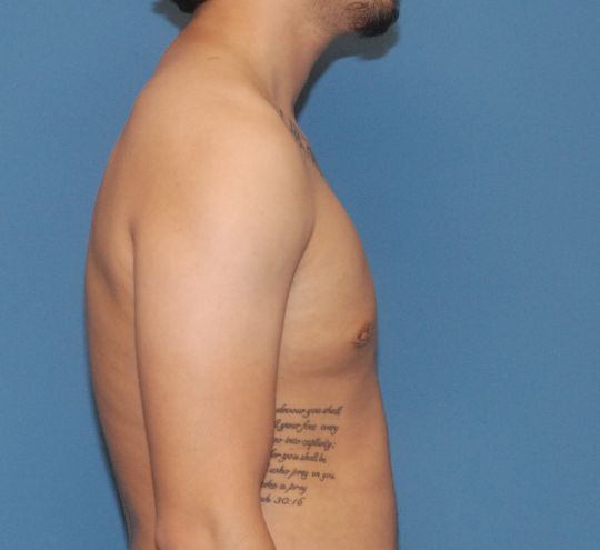 Gynecomastia Before & After