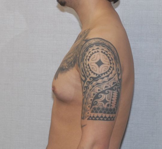 Gynecomastia Before & After