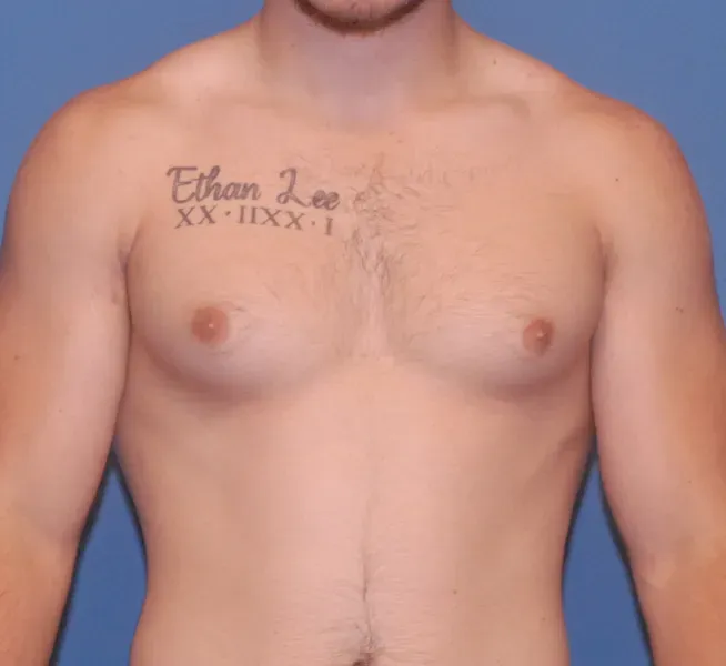 Gynecomastia Before & After