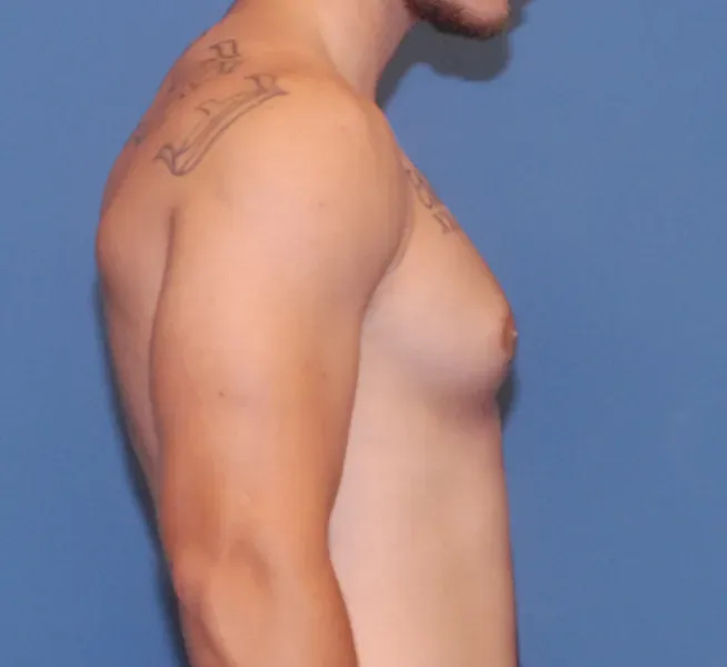 Gynecomastia Before & After
