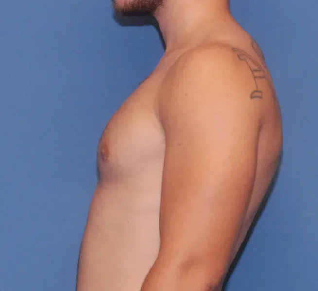 Gynecomastia Before & After