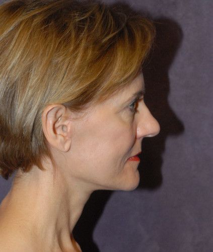 Neck Lift Before & After