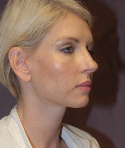 Neck Lift Before & After