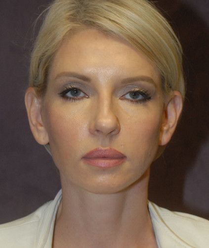 Neck Lift Before & After