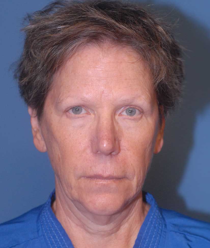 Neck Lift Before & After