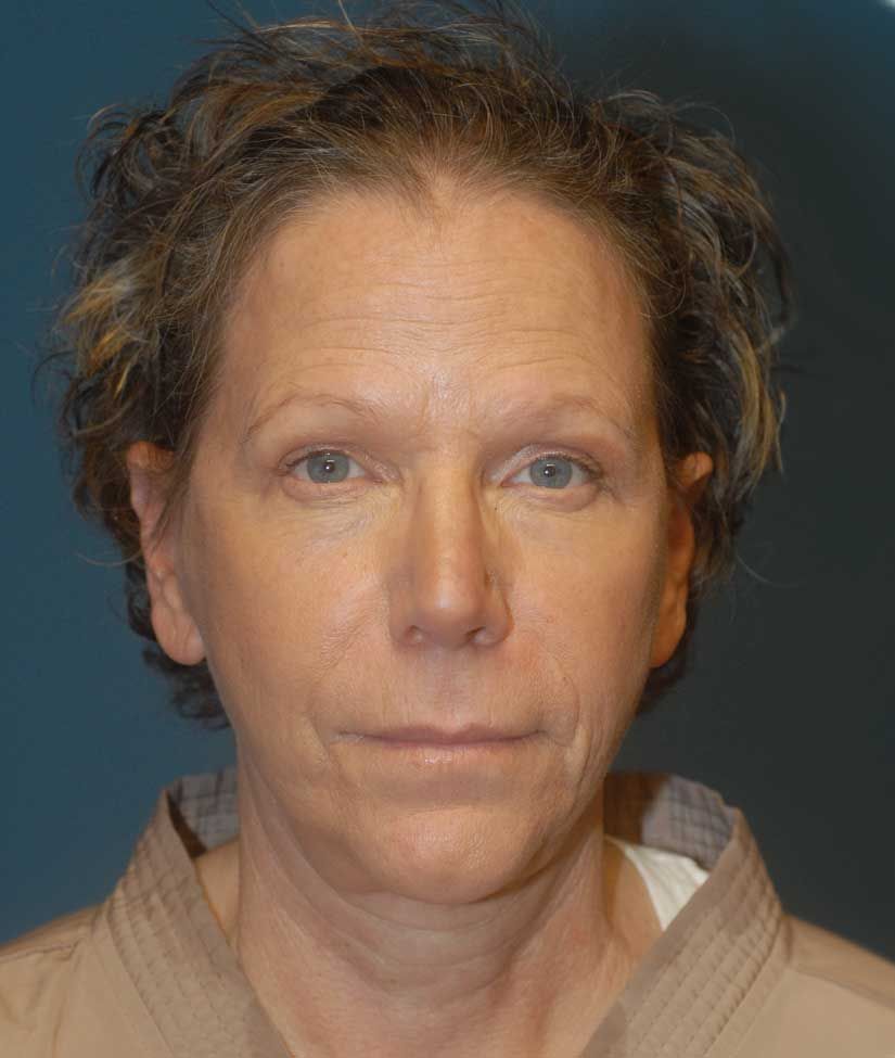 Neck Lift Before & After