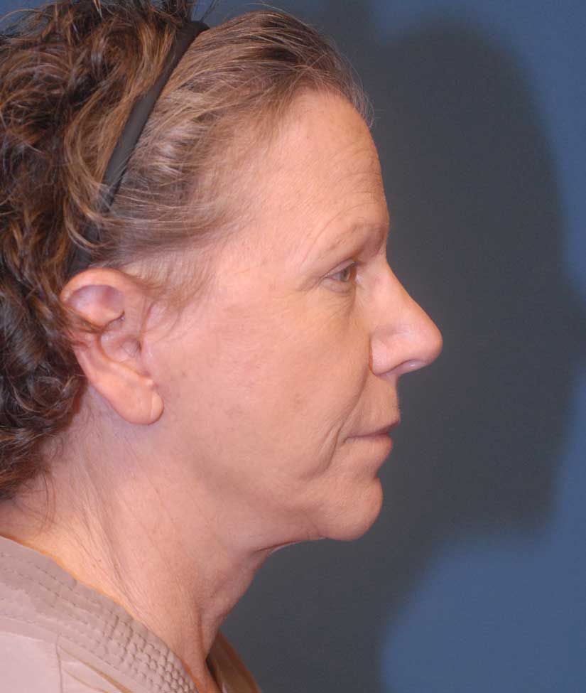 Neck Lift Before & After