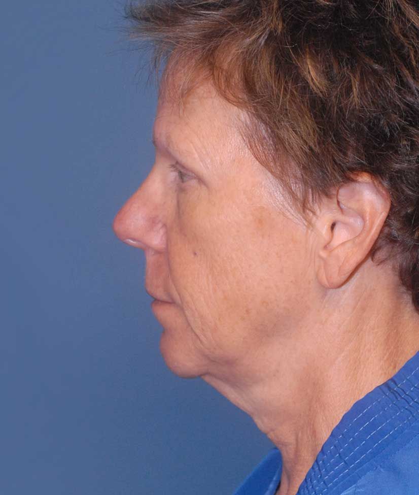 Neck Lift Before & After