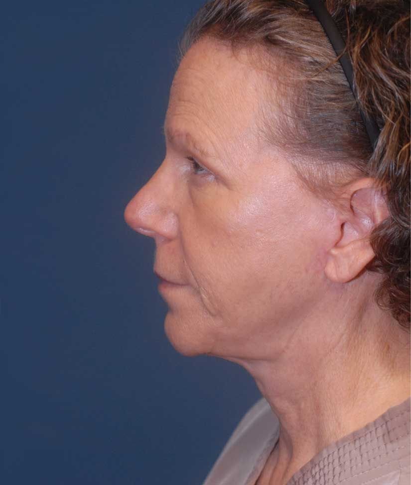 Neck Lift Before & After