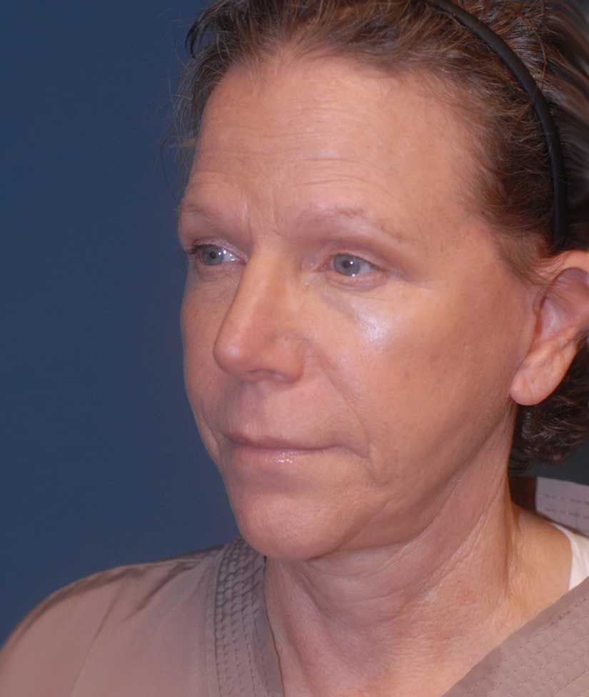 Neck Lift Before & After