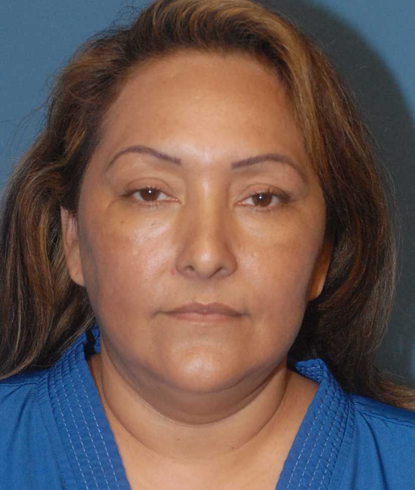 Neck Lift Before & After