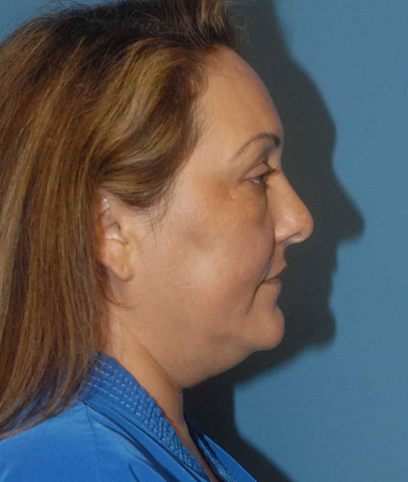 Neck Lift Before & After