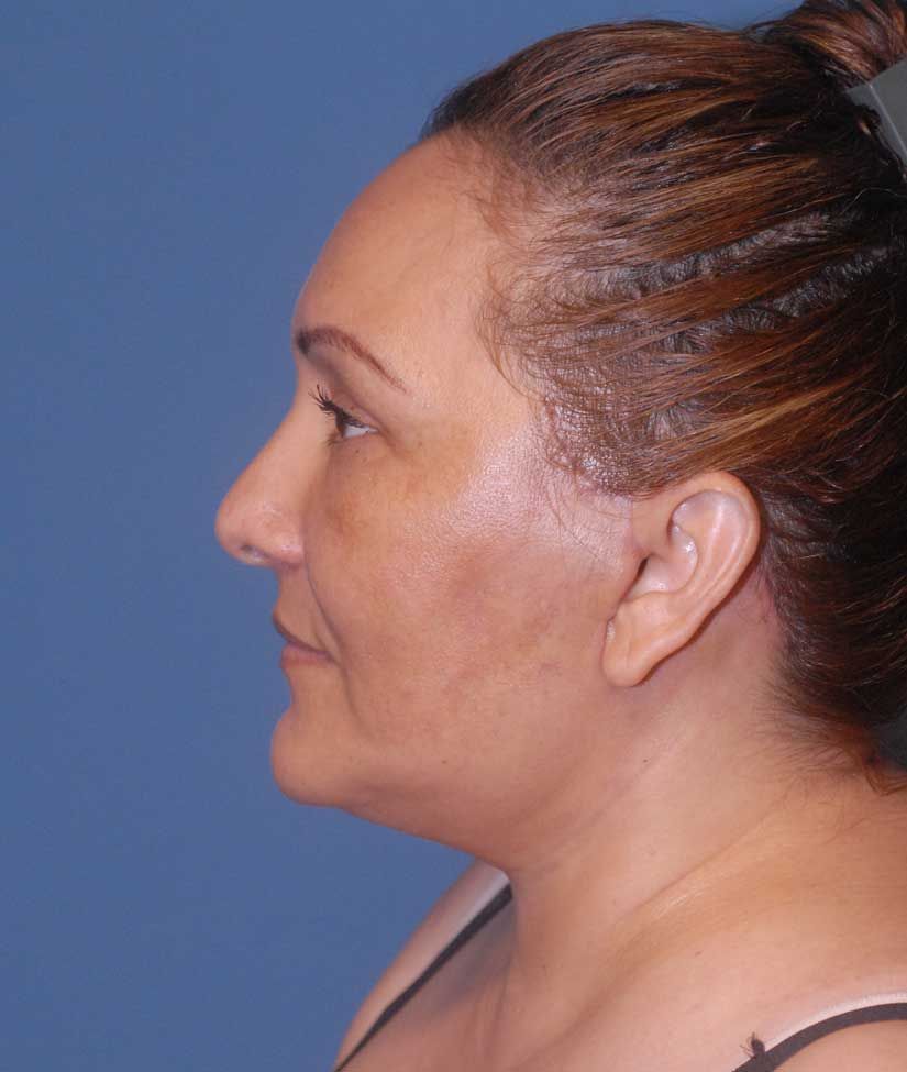Neck Lift Before & After