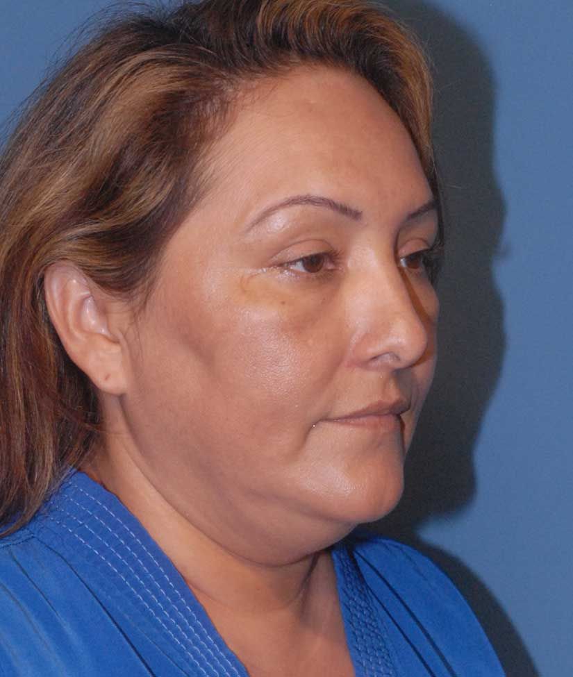 Neck Lift Before & After