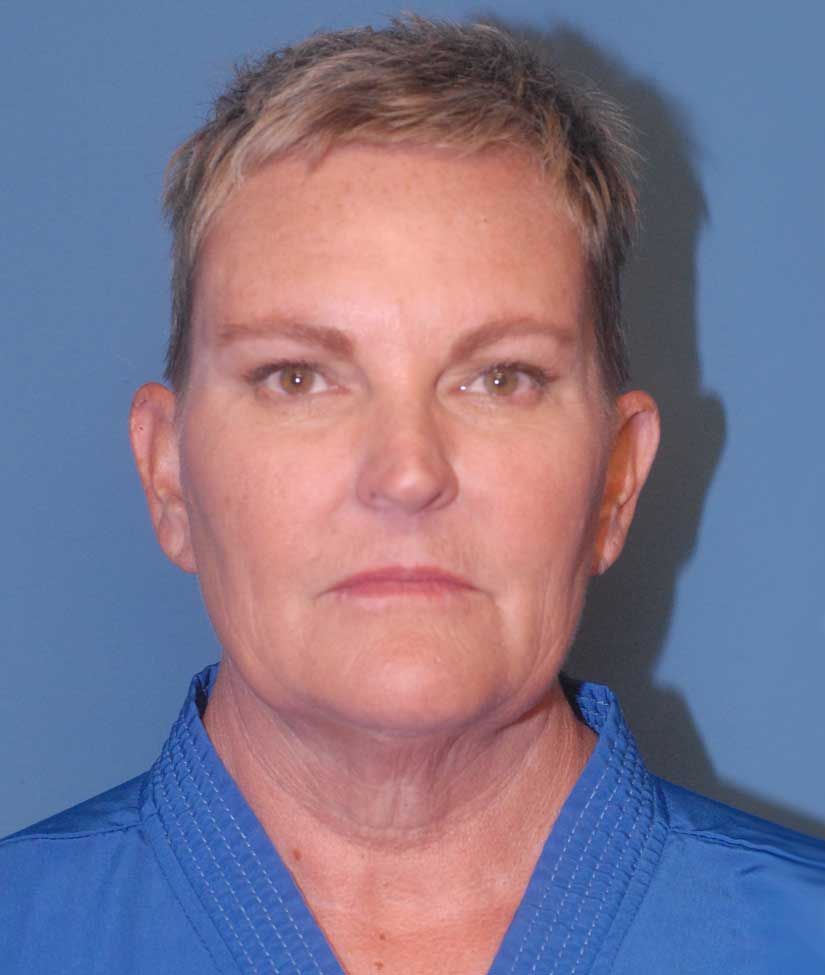 Neck Lift Before & After