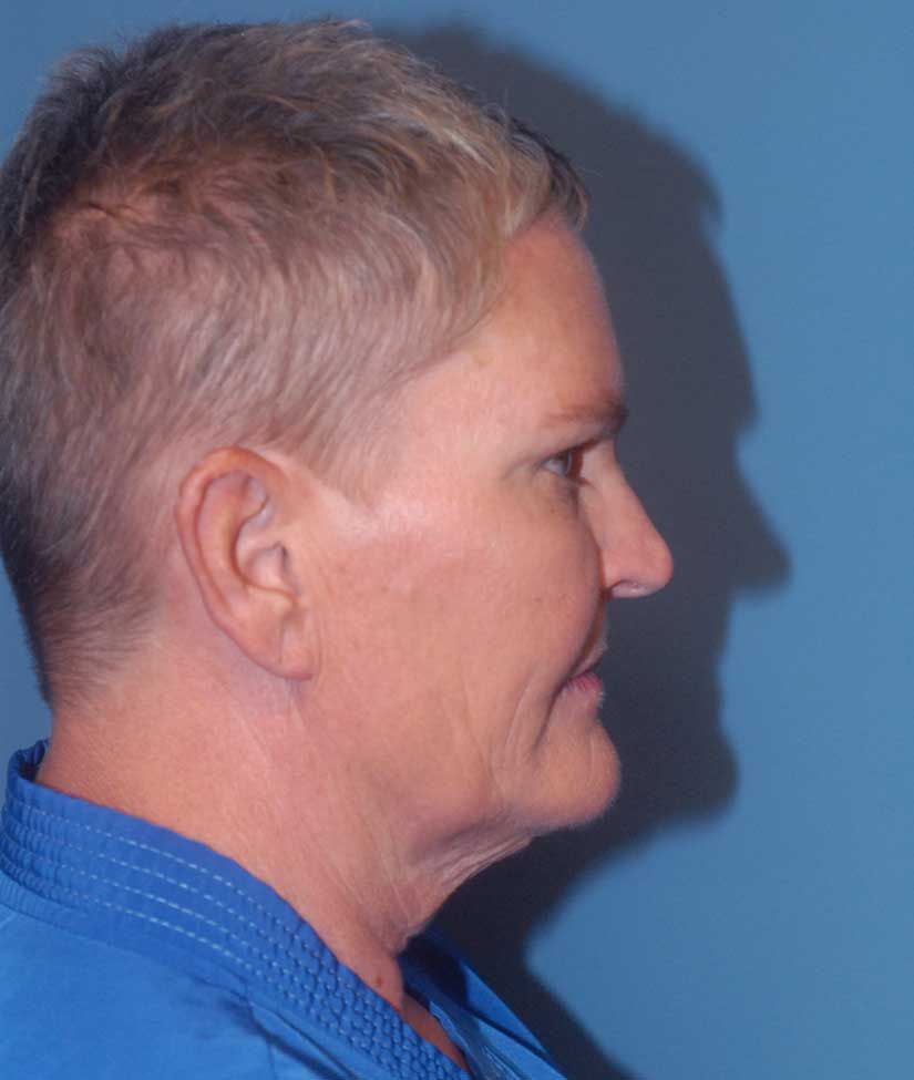 Neck Lift Before & After