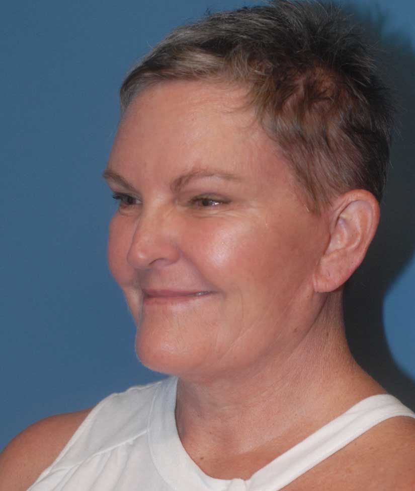 Neck Lift Before & After