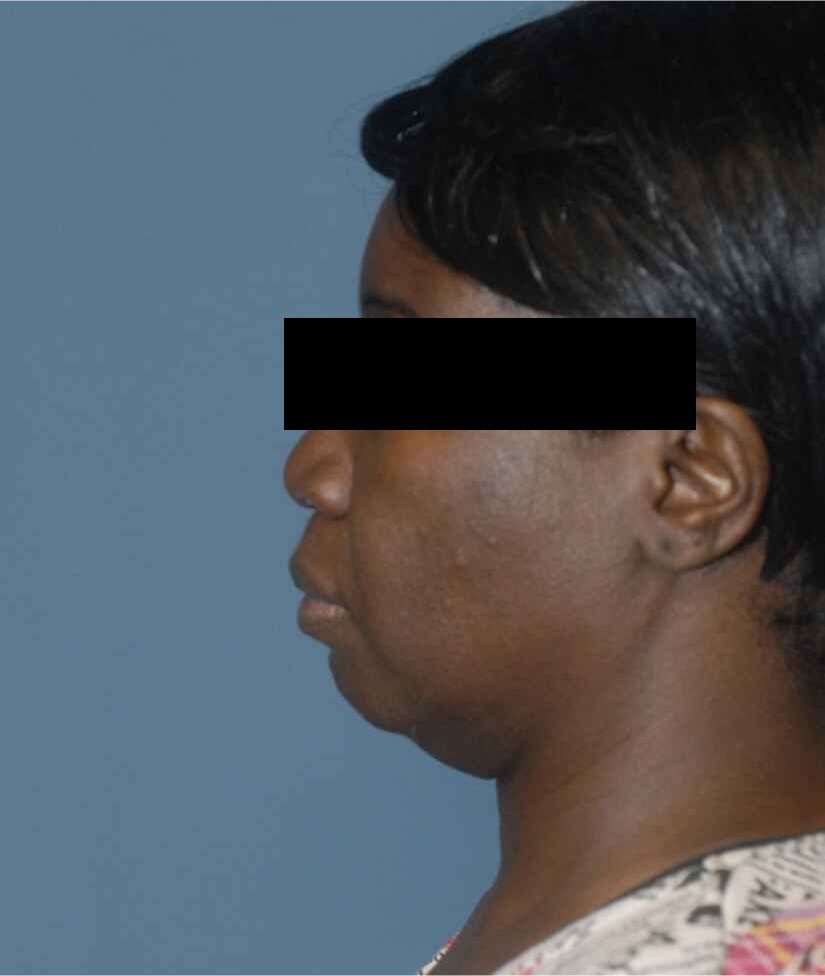 Neck Lift Before & After