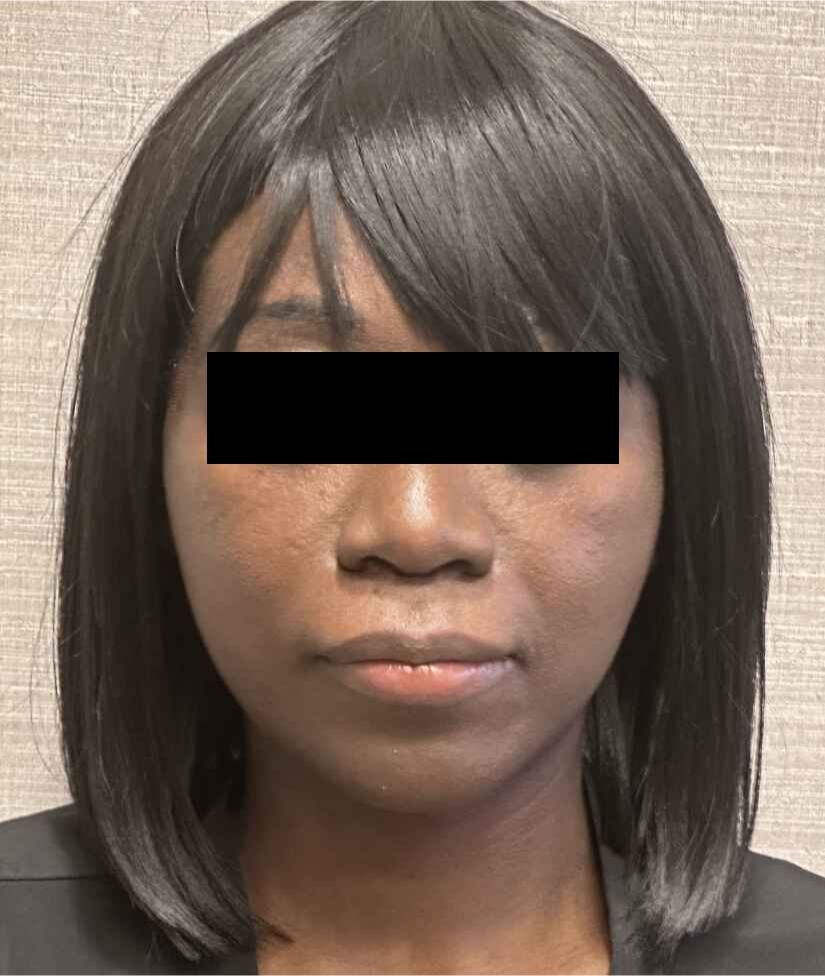 Neck Lift Before & After