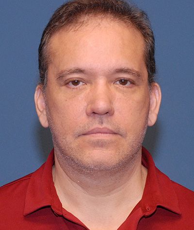 Neck Lift Before & After