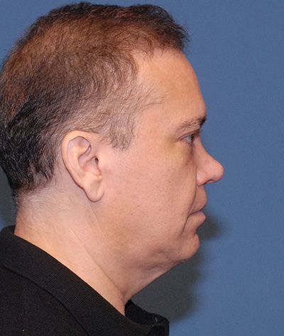 Neck Lift Before & After