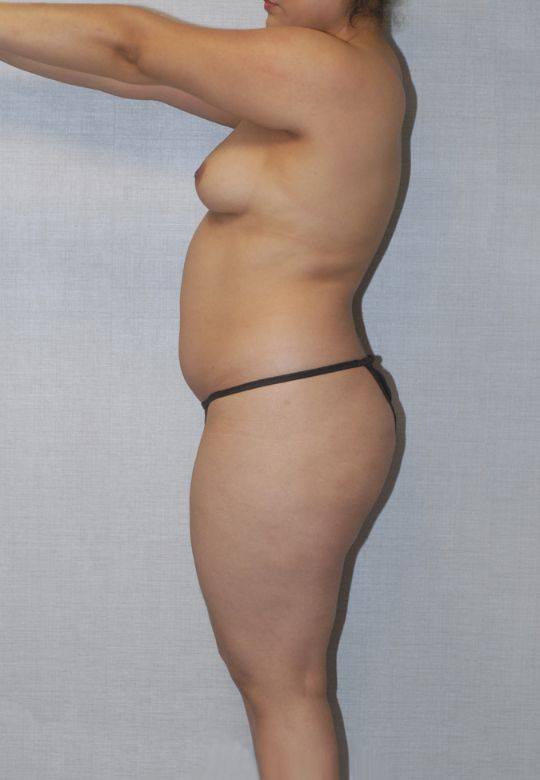 Brazilian Butt Lift Before & After