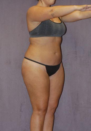 Brazilian Butt Lift Before & After