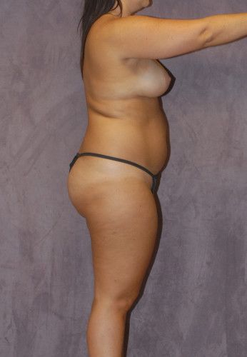 Brazilian Butt Lift Before & After