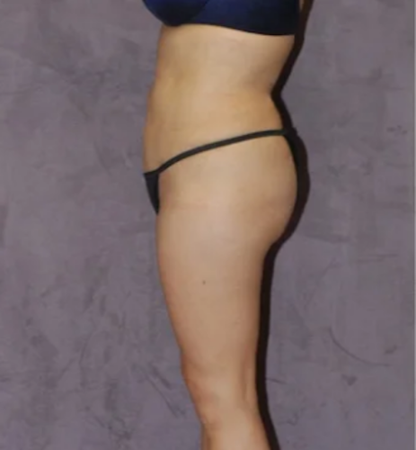 Brazilian Butt Lift Before & After