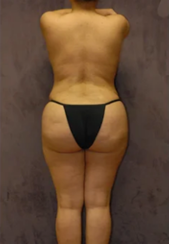Brazilian Butt Lift Before & After