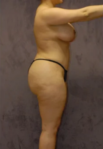 Brazilian Butt Lift Before & After