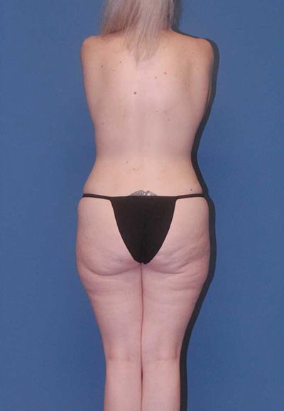Brazilian Butt Lift Before & After