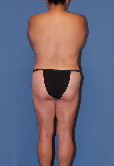 Brazilian Butt Lift Before & After