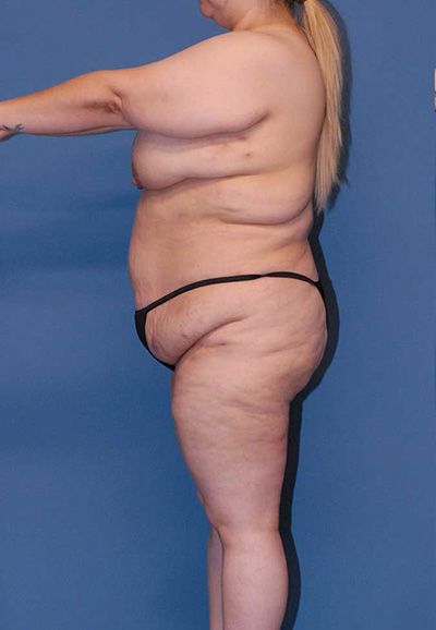 Brazilian Butt Lift Before & After