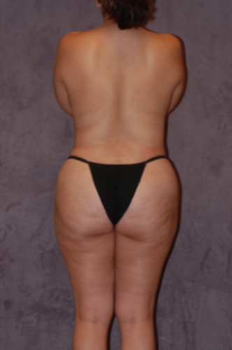 Brazilian Butt Lift Before & After