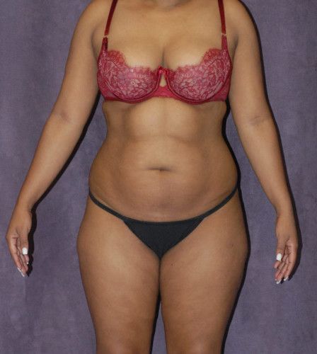 Brazilian Butt Lift Before & After