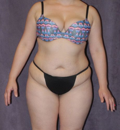 Brazilian Butt Lift Before & After