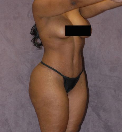 Brazilian Butt Lift Before & After