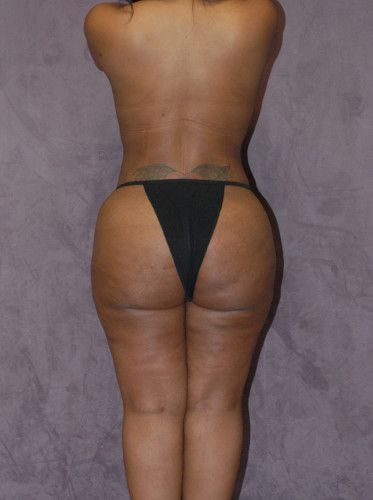 Brazilian Butt Lift Before & After