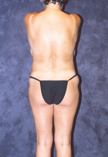 Brazilian Butt Lift Before & After