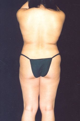 Brazilian Butt Lift Before & After