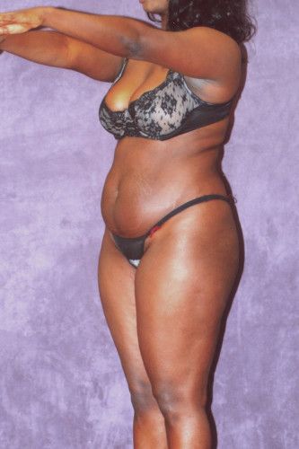 Brazilian Butt Lift Before & After