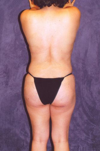 Brazilian Butt Lift Before & After