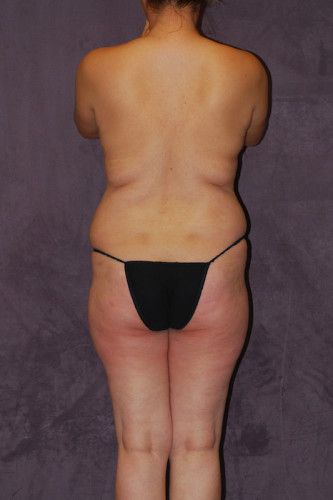 Brazilian Butt Lift Before & After