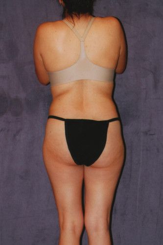 Brazilian Butt Lift Before & After