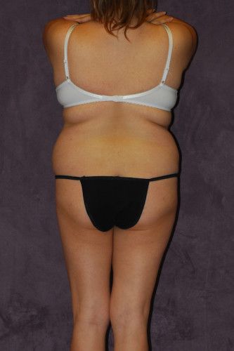 Brazilian Butt Lift Before & After