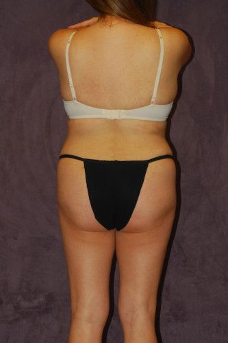 Brazilian Butt Lift Before & After