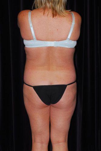 Brazilian Butt Lift Before & After